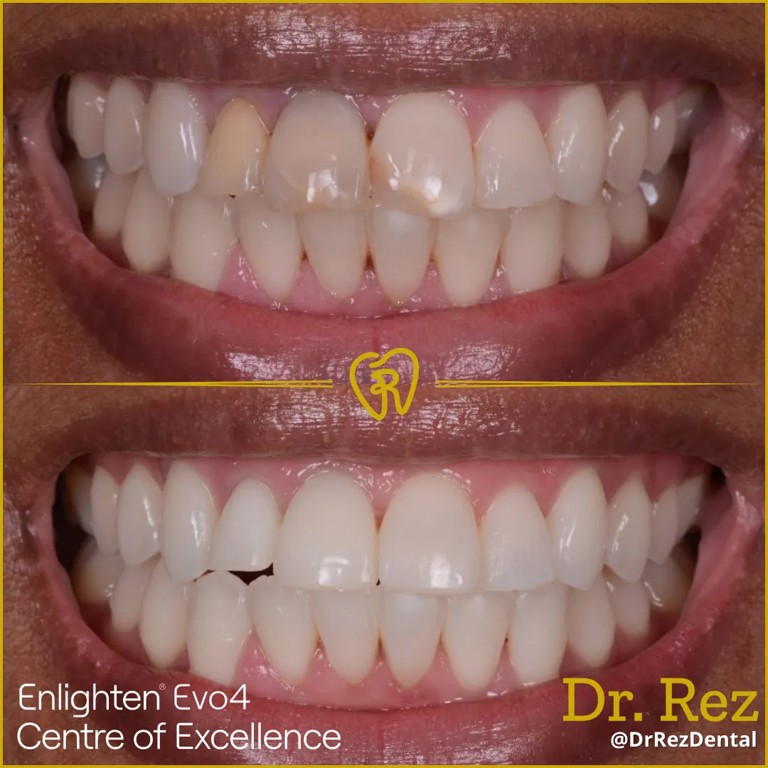 Teeth whitening at Dr Rez Dental in Liverpool Teeth whitening near